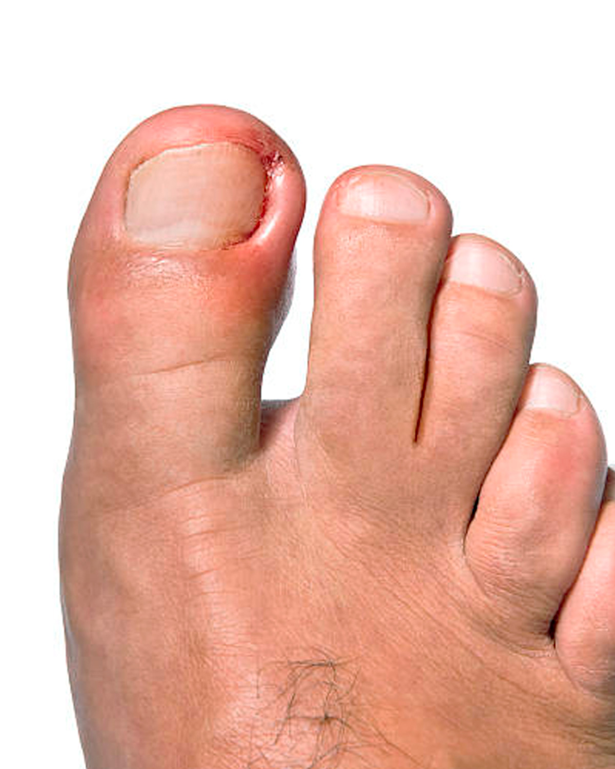 Fungal Nails - The Foot People