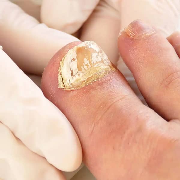 Toenail Fungus Laser