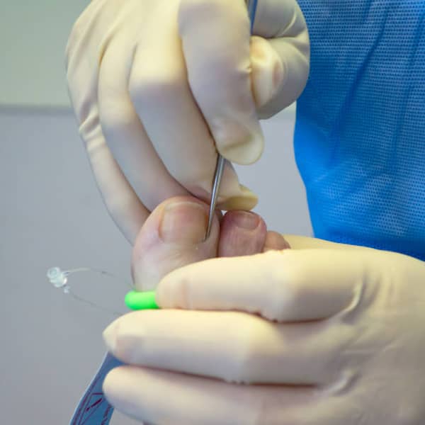 Toenail Surgery